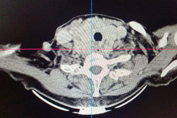 В Клиниках СамГМУ успешно прооперировали сложный случай токсического зоба у пациентки из Пензенской области