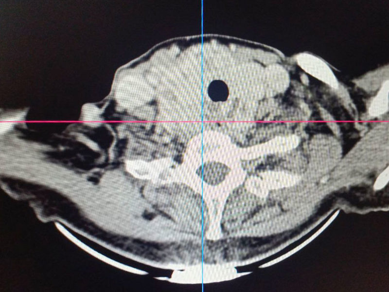 В Клиниках СамГМУ успешно прооперировали сложный случай токсического зоба у пациентки из Пензенской области