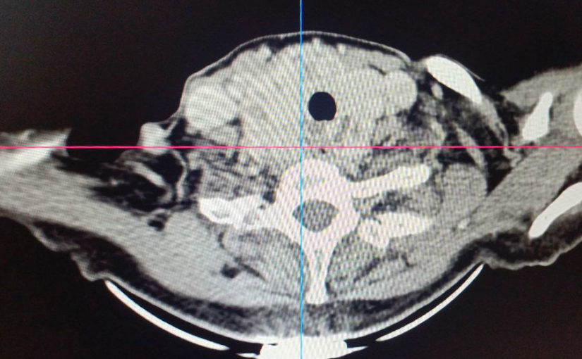 В Клиниках СамГМУ успешно прооперировали сложный случай токсического зоба у пациентки из Пензенской области