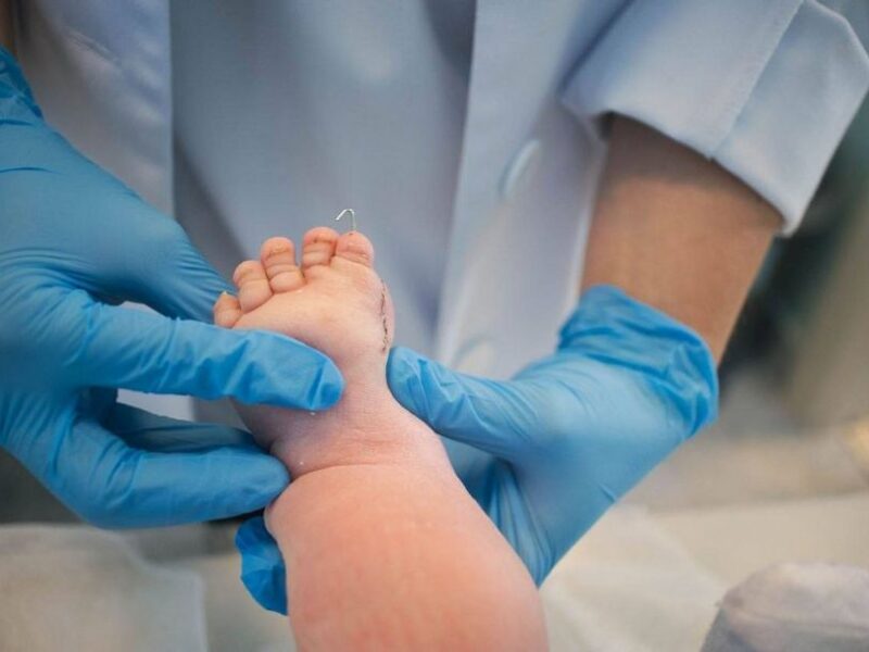 В СамГМУ спасают ногу двухмесячному пациенту с редкой формой гемимелии